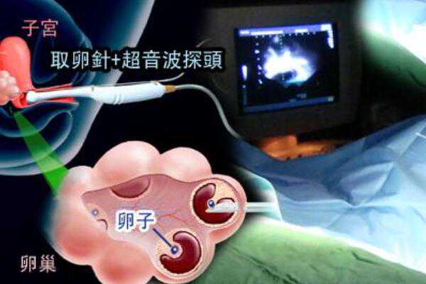昆明代孕是怎么回事,输卵管造影后休息几天输卵管造影后能做试管婴儿-北京妇